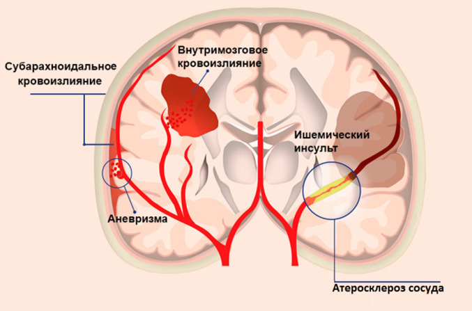 Работа мозга с сосудистой деменцией