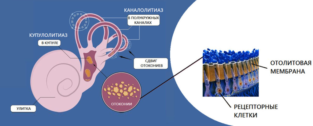 Доброкачественное позиционное пароксизмальное головокружение