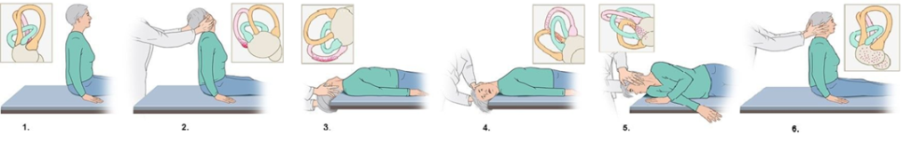 Перемещение отокониев методом Эпли