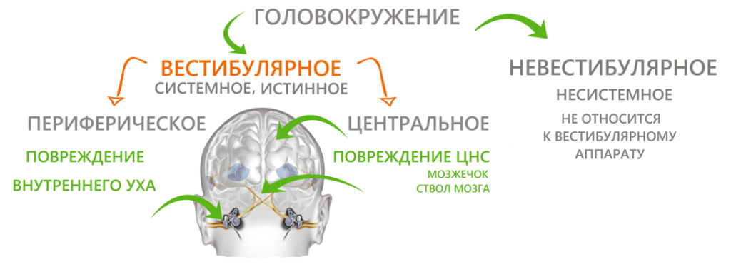 Виды головокружений