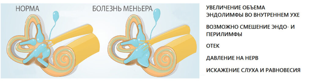 Болезнь Меньера